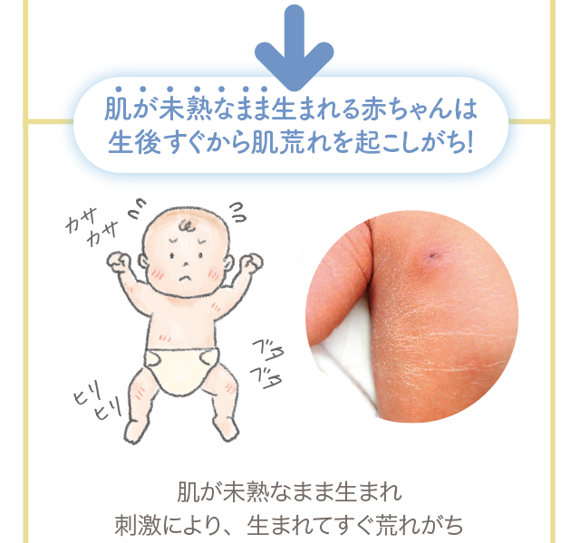 肌が未熟なまま生まれる赤ちゃんは 生後すぐから肌荒れを起こしがち！ 肌が未熟なまま生まれ刺激により、生まれてすぐ荒れがち