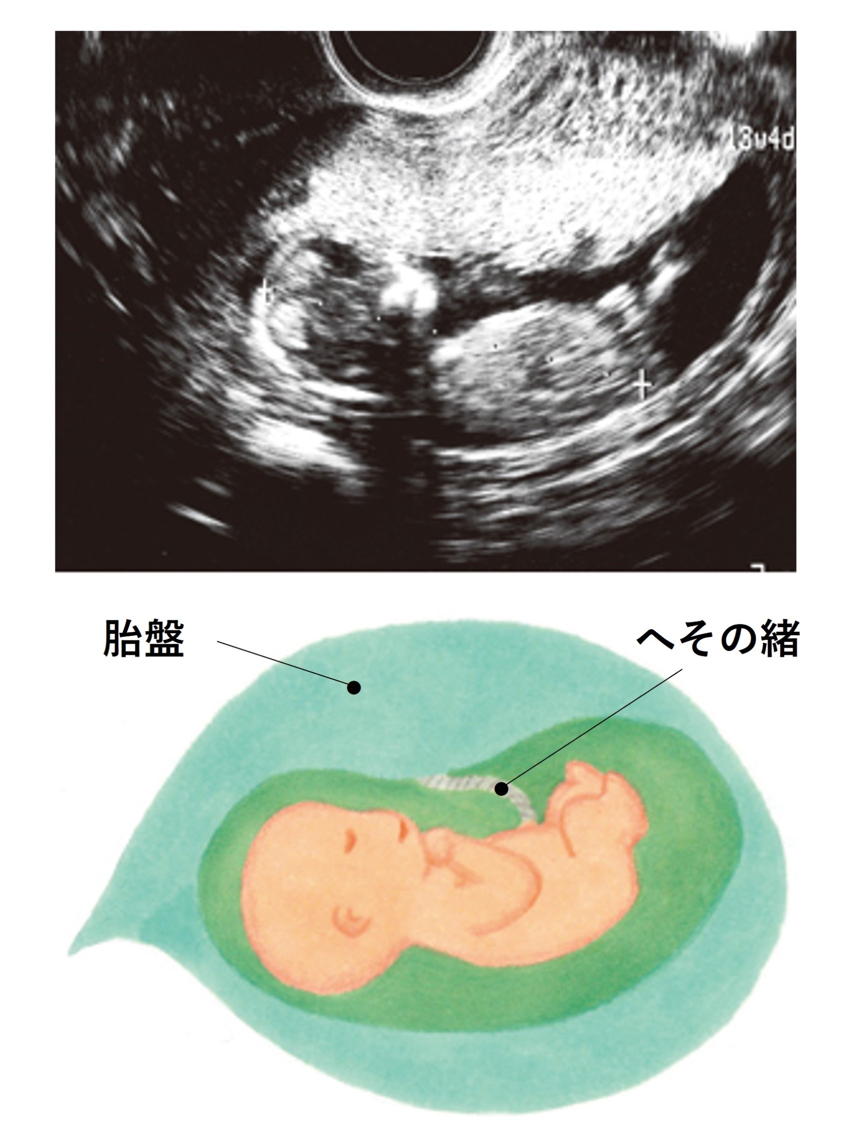 妊娠13週のエコー写真。胎盤の完成まであと少し。胎盤の中央あたりから、へその緒が出ていることも確認できます。