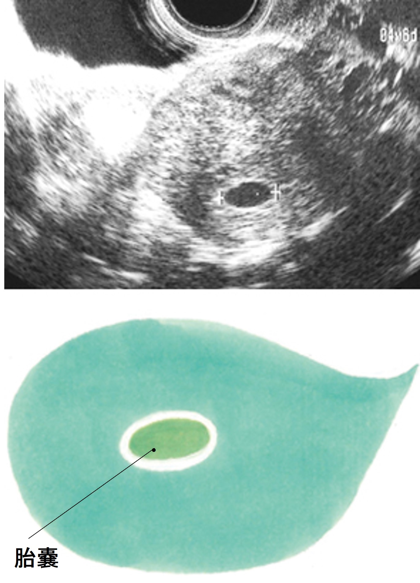 妊娠4週後半ころのエコー写真。中央の小さな黒いだ円が胎嚢です