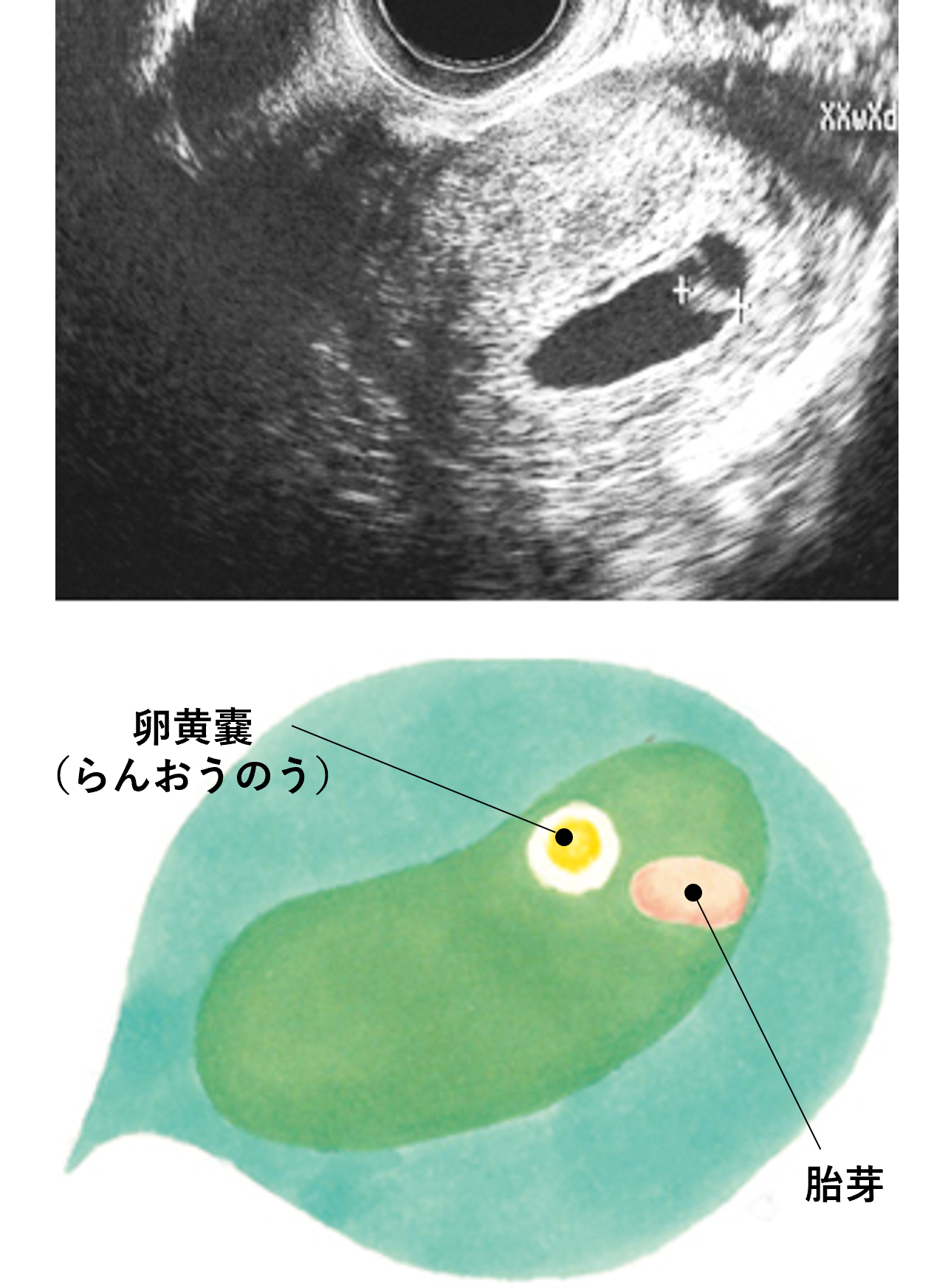 妊娠5週目のおなかの赤ちゃんの様子